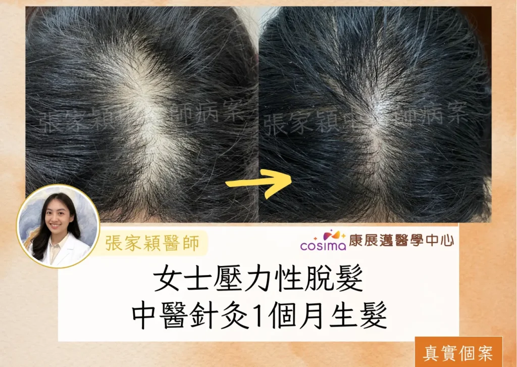 [真實個案]女士壓力性脫髮,中醫針灸療程1個月生髮