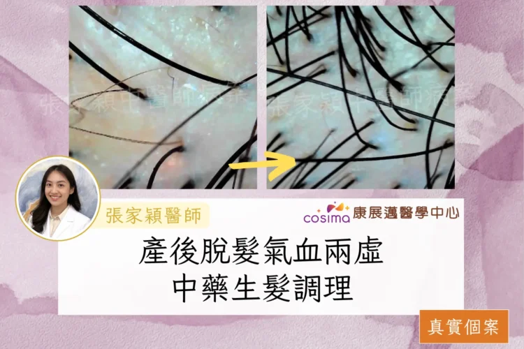 [真實個案]每日掉髮200根?!中醫治療女性產後脫髮：原因,症狀,治療