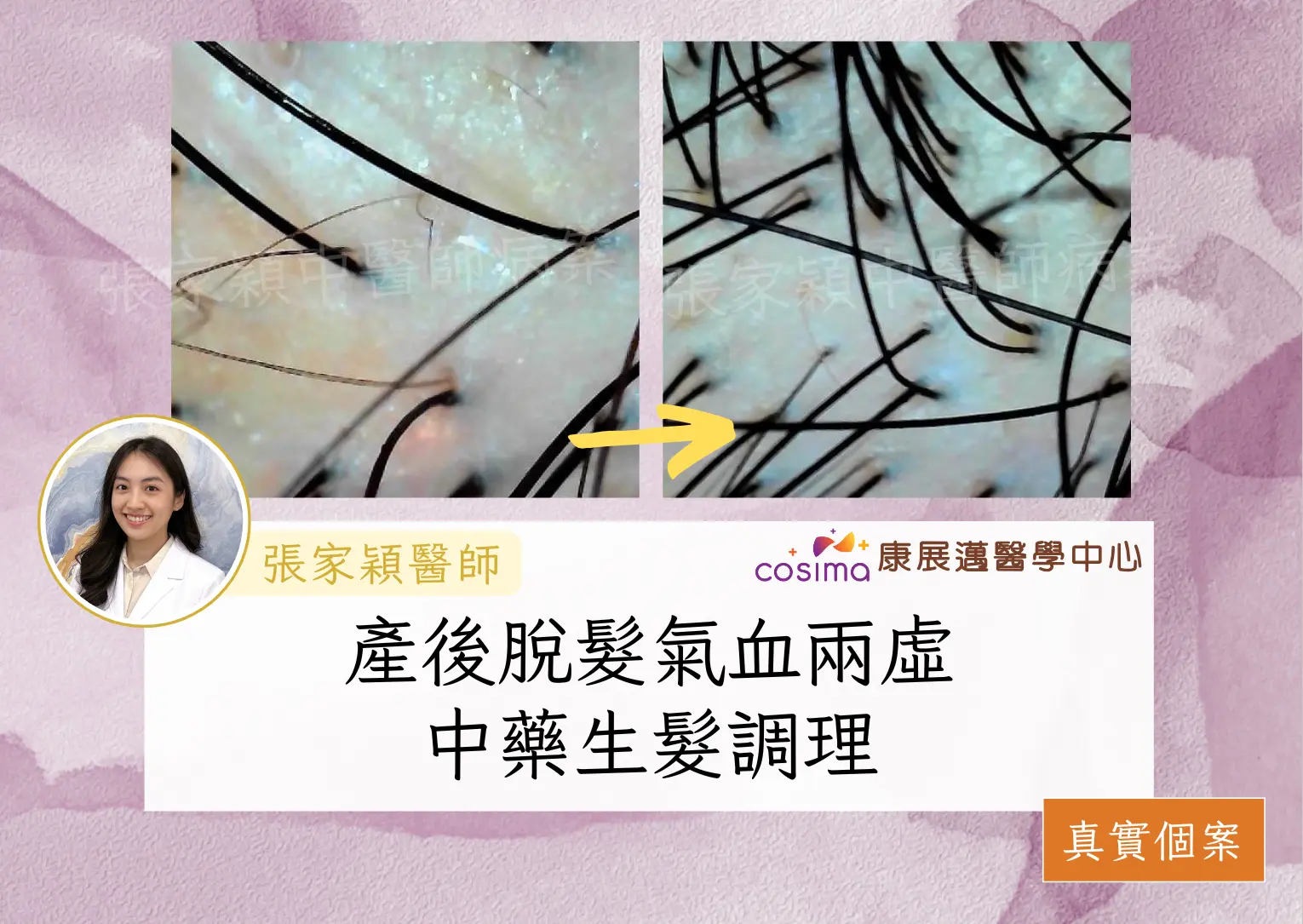 [真實個案]每日掉髮200根?!中醫治療女性產後脫髮：原因,症狀,治療