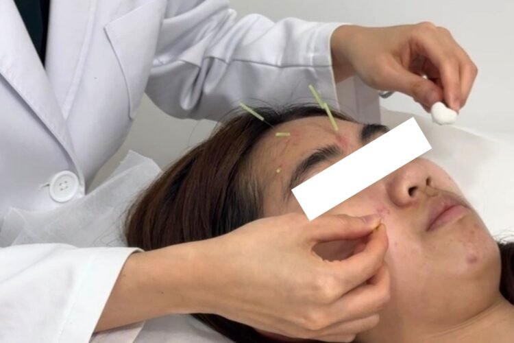 中醫推薦治療暗瘡針藥並用? 背部下巴額頭暗瘡位置代有何有分別?